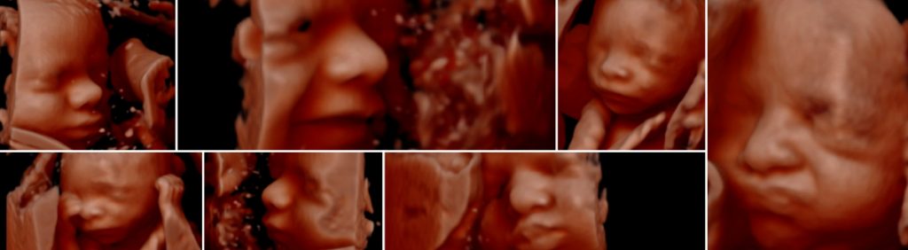 3D Ultrasound Image Collage