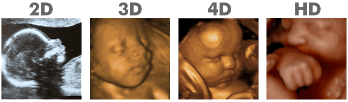 2d,3d,4d Ultrasound Compared