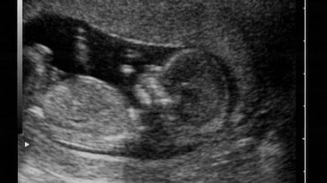 Depicting Gender In An Ultrasound